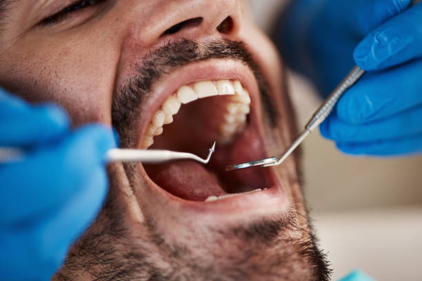 Best Emergency Tooth Extraction in Pecan Acres, TX